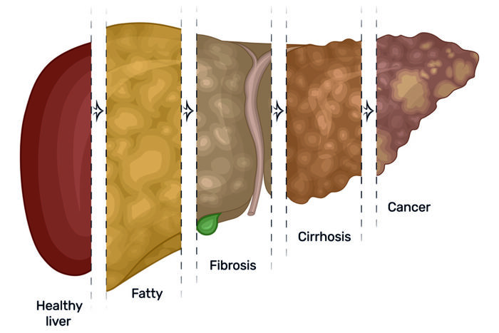 Illustration Of The Gradual Damage Of The Liver